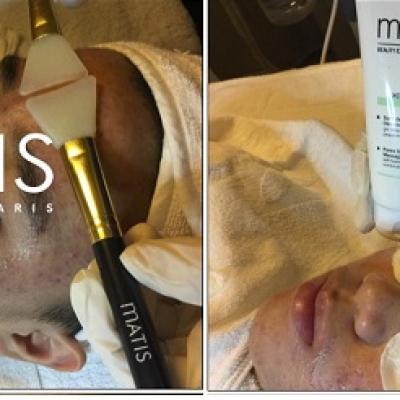 Lưu ý khi sử dụng lợi khuẩn trong liệu trình trị mụn và thải độc Corticoid